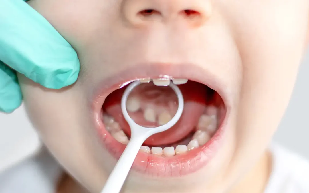 Denti Storti nei Bambini: Interventi Senza Stress a Roma San Giovanni