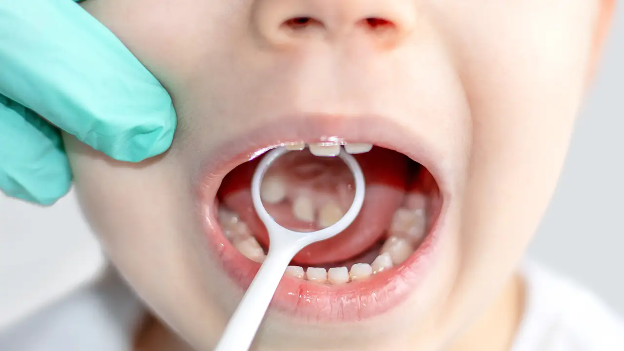 Denti Storti nei Bambini - Dr. Emanuele Ciulli - Odontoiatria Estetica e Infantile, Roma