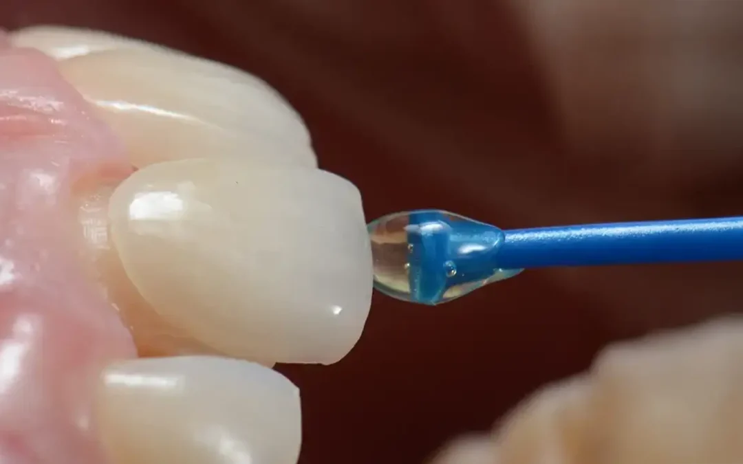Faccette Dentali: Il Segreto di un Sorriso Naturale – Dr. Emanuele Ciulli