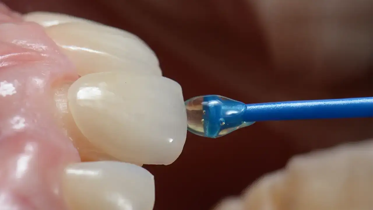 Faccette Dentali - Il Segreto di un Sorriso Naturale - Dr. Emanuele Ciulli - Odontoiatria Estetica e Infantile, Roma