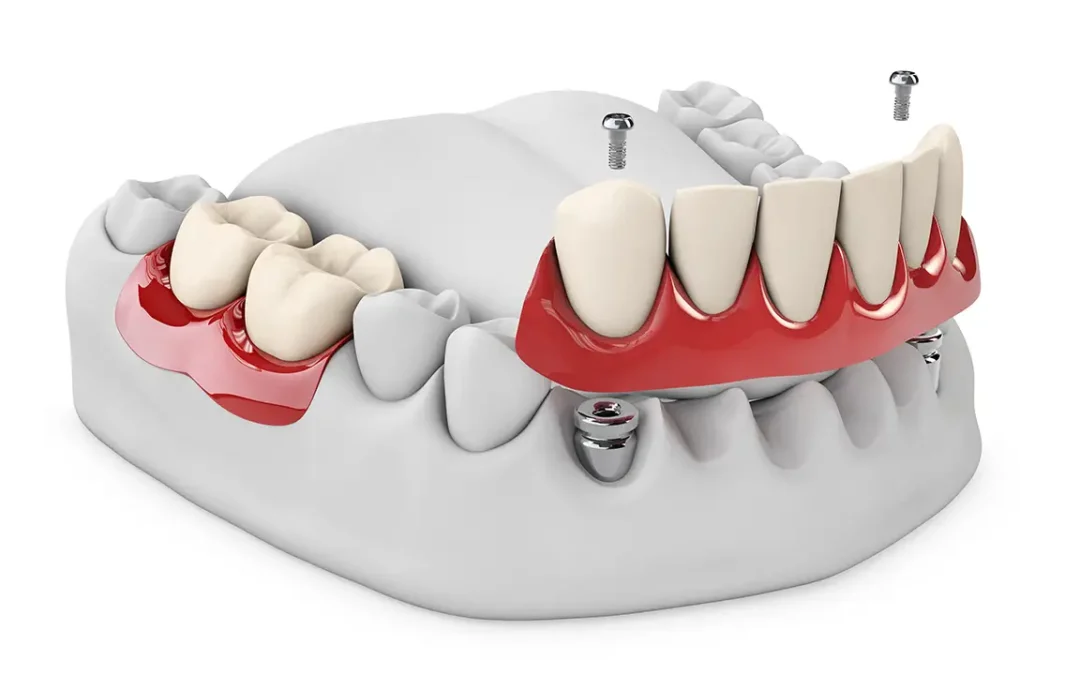 Impianti Dentali Sottoperiostei a Roma San Giovanni