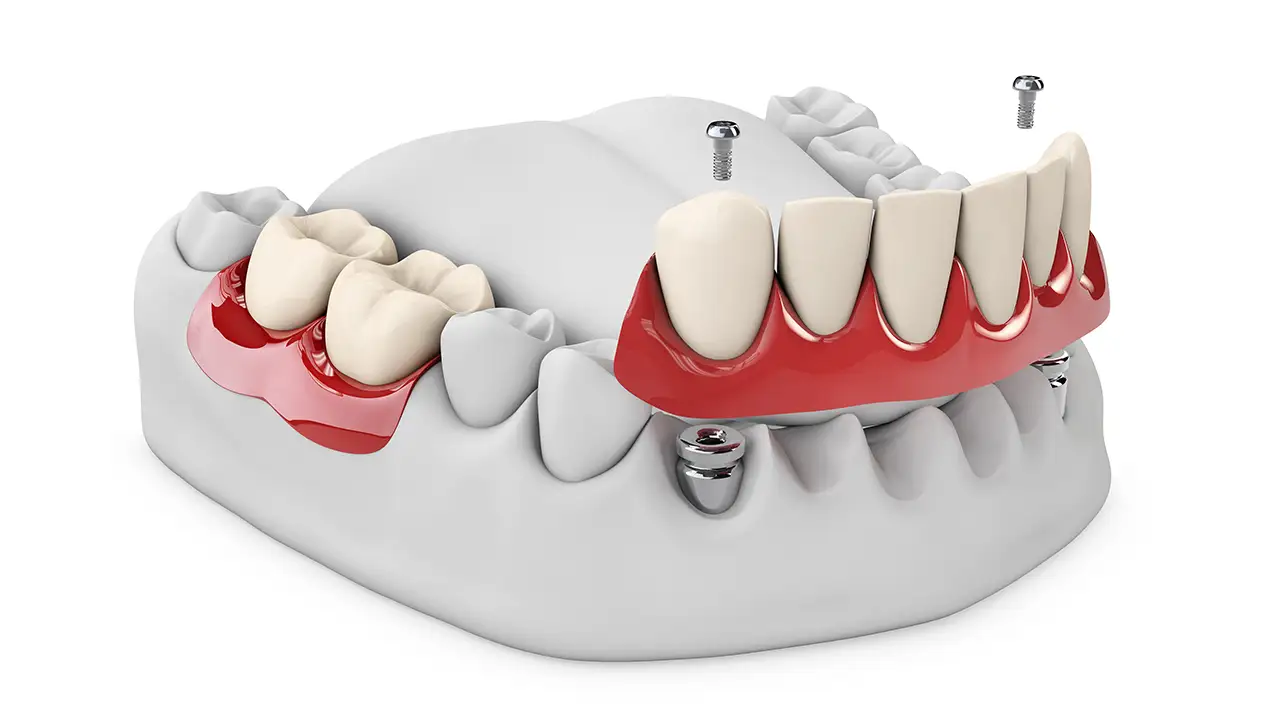 Impianti Dentali Sottoperiostei a Roma San Giovanni - Dr. Emanuele Ciulli - Odontoiatria Estetica e Infantile, Roma